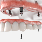 Cấy ghép implant