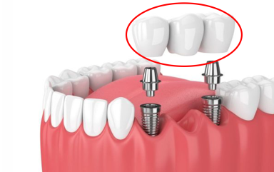 Phục hình răng trên Implant