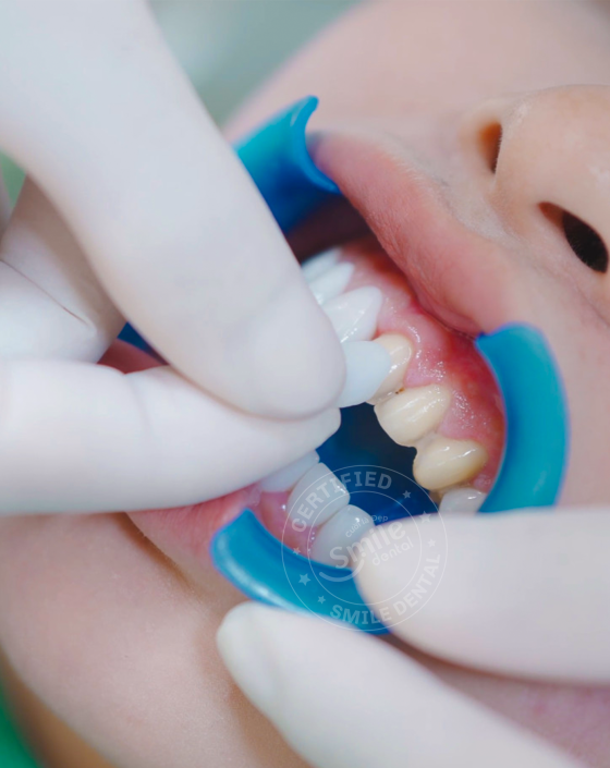QUY TRÌNH DÁN SỨ VENEER TẠI NHA KHOA SMILE