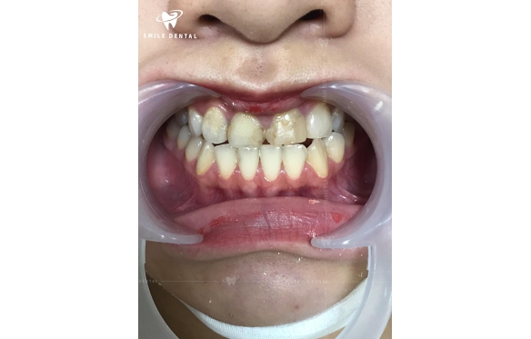 Bọc sứ răng cửa bao nhiêu tiền? Giá mới nhất tại Nha Khoa Smile