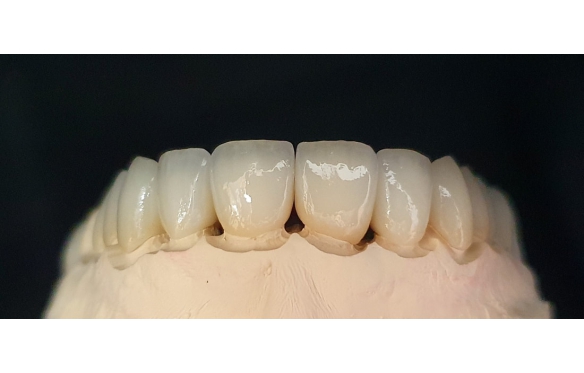 Răng Sứ Cercon HT - Địa Chỉ Bọc Sứ Uy Tín Tại Miền Tây