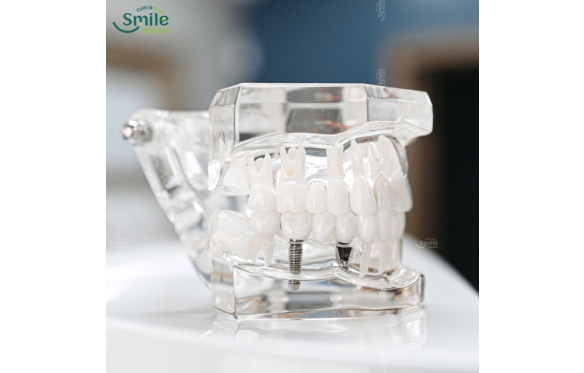 Răng Sứ Trên Implant Giá Bao Nhiêu? Cập Nhật Chi Phí Và Quy Trình Tại Smile Dental