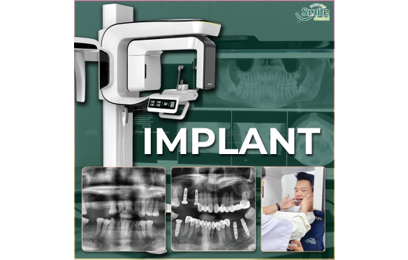Bảng Giá Cấy Ghép Implant Tại Nha Khoa Smile | Minh Bạch, Chất Lượng Cao