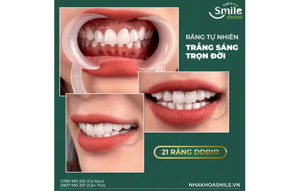Răng Sứ DDBIO Có Tốt Không? Đánh Giá Chi Tiết Từ Nha Khoa Smile