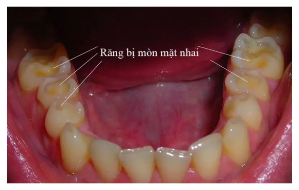 Răng Bị Mòn? Giải Pháp Bọc Sứ Tại Cần Thơ Từ Nha Khoa Chuyên Gia