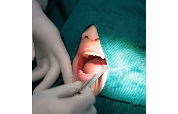 Nên Làm Cầu Răng Sứ Hay Trồng Implant? Tư Vấn Từ Nha Khoa Smile