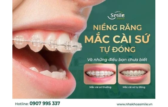 Niềng răng mắc cài sứ tự đóng là gì