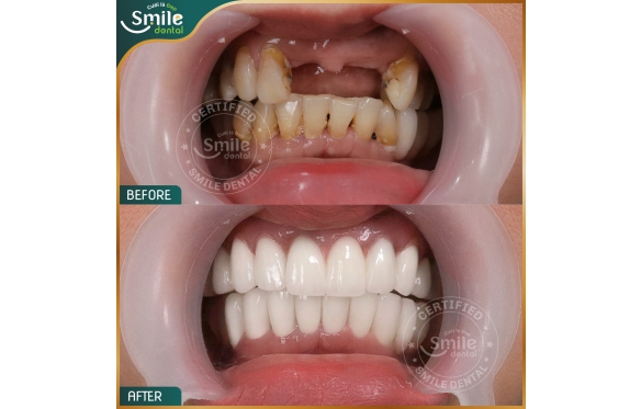 Phục Hình Răng Sứ Tại Cần Thơ Với Nha Khoa Smile