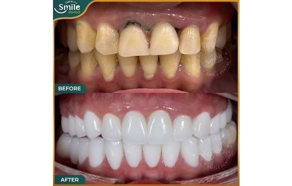 Bọc Răng Sứ Có Tốt Không? Đánh Giá Chi Tiết Tại Nha Khoa Smile