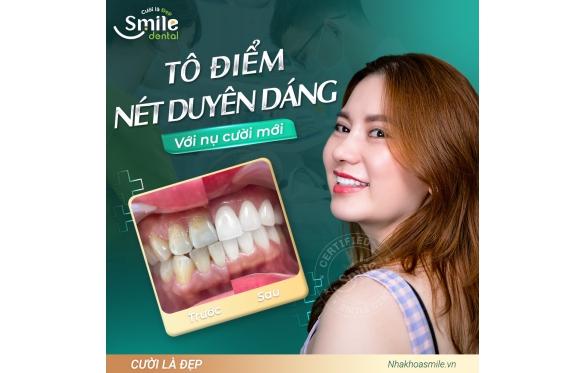Răng thưa có nên bọc răng sứ không? Tư vấn chuyên môn từ Nha khoa Smile