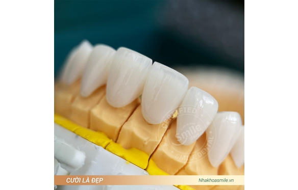 Trồng Răng Sứ Giá Bao Nhiêu 1 Chiếc? Từ Implant Đến Các Giải Pháp Vĩnh Viễn tại Nha Khoa Smile