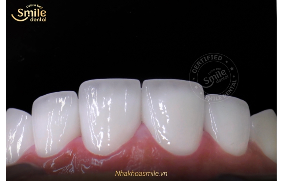 Răng Sứ Được Bao Nhiêu Năm? Bí Quyết Giữ Răng Sứ Luôn Bền Đẹp | Nha Khoa Smile