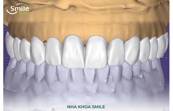 Phủ răng sứ có tốt không? Tìm hiểu về lợi ích và quy trình phủ răng sứ tại Nha Khoa Smile