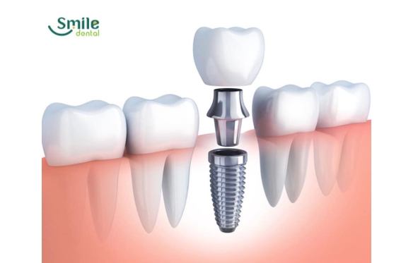 Nha sĩ cấy ghép Implant miền Tây được đánh giá cao – Smile Dental