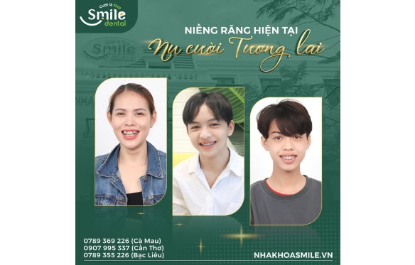 Niềng răng minivis là gì? Giá, quy trình và hiệu quả điều trị