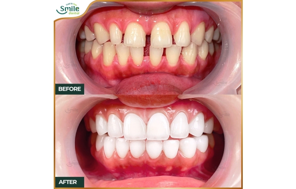 Răng Sứ Cho Răng Thưa Cần Thơ | Khắc Phục Hiệu Quả, Tự Tin Tỏa Sáng | Smile Dental