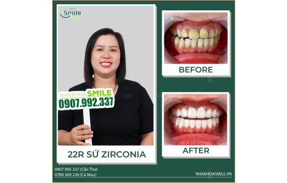 Bọc Răng Sứ Tại Miền Tây Cần Thơ Giúp Cải Thiện Thẩm Mỹ Như Thế Nào