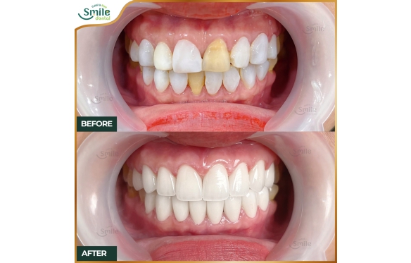 Răng Sứ Cũ ? Giải Pháp Bọc Sứ Tại Cà Mau Từ Nha Khoa Smile Chuyên Gia 