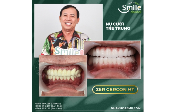Răng Sứ Cũ ? Giải Pháp Bọc Sứ Tại Cần Thơ Từ Nha Khoa Chuyên Gia