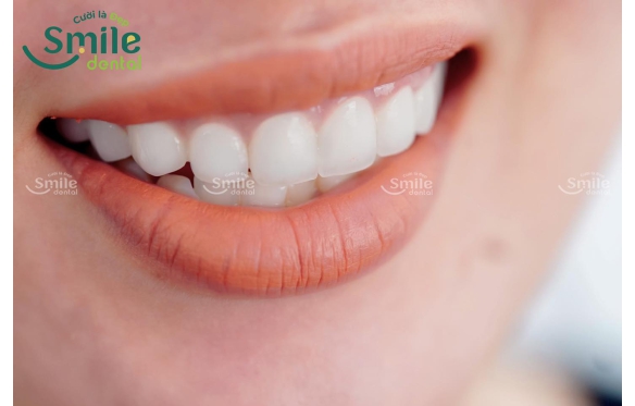 Chi phí trồng răng sứ và những điều bạn nên biết