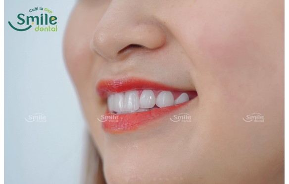 Răng sứ Lava của nước nào, có gì nổi bật, giá bao nhiêu ?