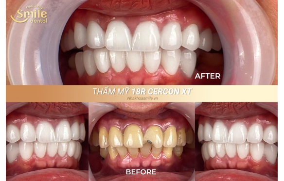 Bọc Răng Sứ Cercon Giá Bao Nhiêu? Cập Nhật Giá Mới Tại Nha Khoa Smile