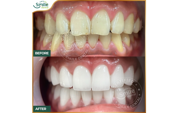 Bọc Răng Sứ Cho Răng Hô Nhẹ Tại Cà Mau: Giải Pháp Nhanh Chóng & Hiệu Quả 