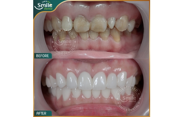 Răng Sứ Cũ ? Giải Pháp Bọc Sứ Tại Vĩnh Long Từ Nha Khoa Chuyên Gia tại Nha Khoa Smile