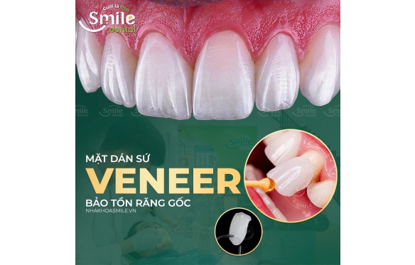 What Is a Porcelain Veneer? Everything You Need to Know Before Getting One