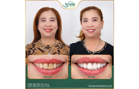 Dịch vụ bọc răng sứ thẩm mỹ – Giá tốt, bảo hành rõ ràng tại Nha Khoa Smile