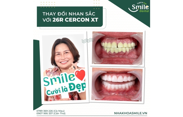 Răng Sứ Cercon Là Gì? Có Tốt Không? Giá Bao Nhiêu? – Nha Khoa Smile