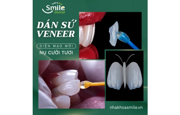 Dán Răng Sứ Tự Nhiên, An Toàn, Thẩm Mỹ Cao Tại Nha Khoa Smile