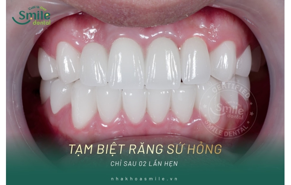 Chi phí bọc răng sứ bao nhiêu tiền? Cập nhật bảng giá mới 2025