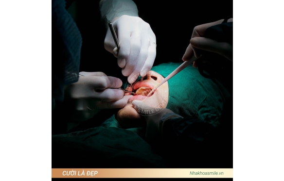 Làm Răng Sứ Implant An Toàn, Bền Đẹp Tại Nha Khoa Smile