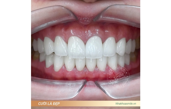 Răng Sứ Chính Hãng 100% An Giang Với Bảo Hành Vượt Trội - Nha Khoa Smile 