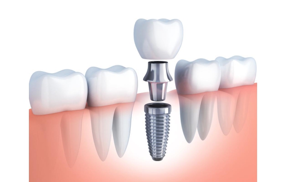 Dịch Vụ Cấy Ghép Implant Tại Nha Khoa Smile Hậu Giang