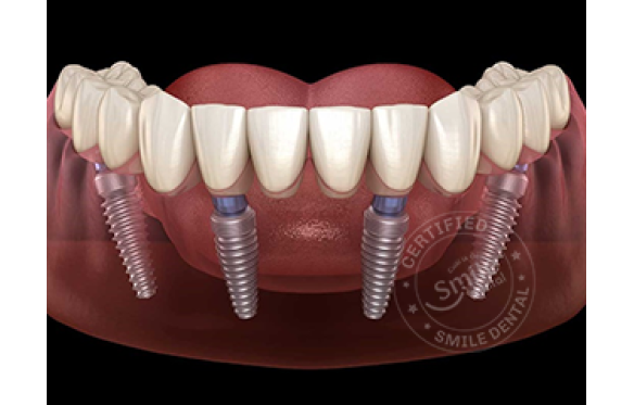 All-on-4 Implant: Giải Pháp Tối Ưu Cho Răng Miệng Khỏe Mạnh Tại Nha Khoa Smile