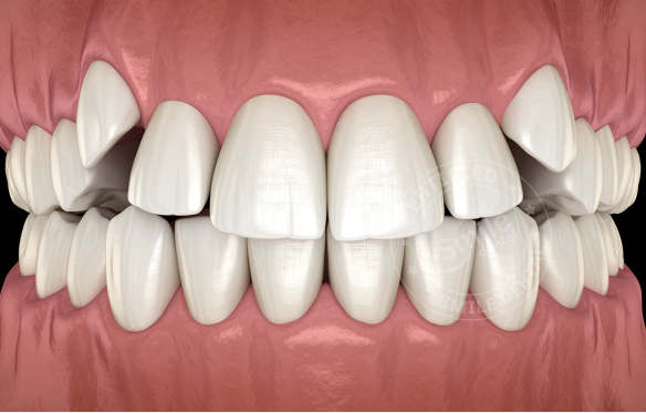 Răng Khấp Khểnh: Nguyên Nhân, Ảnh Hưởng & Giải Pháp Hiệu Quả