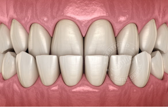 KHỚP CẮN NGƯỢC