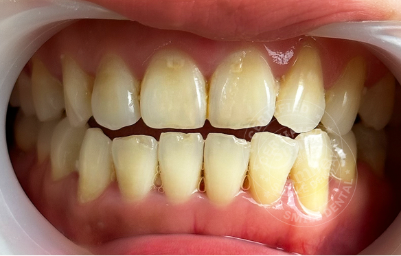 Răng ngắn dài không đều hậu quả ra sao