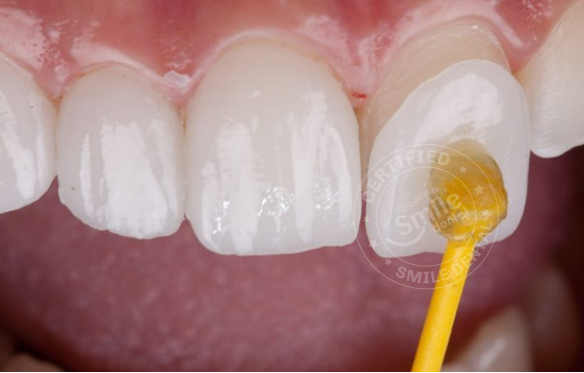 DÁN SỨ VENEER THẨM MỸ