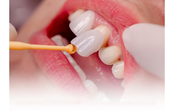 Giá Dán Sứ Veneer Mới Nhất 2024: Dịch Vụ Thẩm Mỹ Răng Uy Tín Tại Nha Khoa Smile 