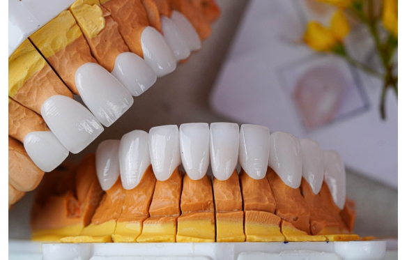 Răng Sứ Chính Hãng 100% Vĩnh Long Với Bảo Hành Vượt Trội - Nha Khoa Smile 