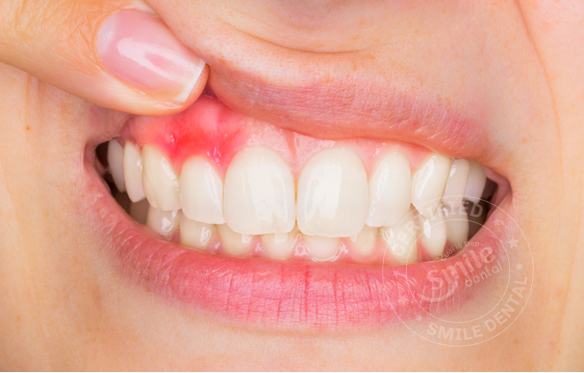 Bọc răng sứ bị dị ứng là gì? Dấu hiệu nhận biết? Cách điều trị?