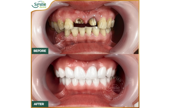 Bọc Răng Sứ Cho Răng Vỡ Tại Nha Khoa Smile miền Tây Cần Thơ