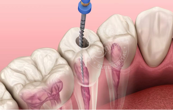 Bọc răng sứ có cần lấy tủy không? Trường hợp nào cần? Đau không?