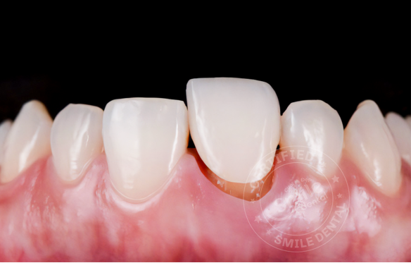 Răng Sứ Tháo Ra Có Lắp Lại Được Không? Giải Đáp Từ Chuyên Gia