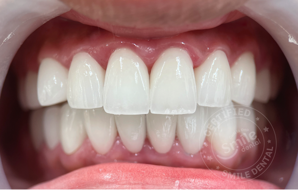 Bọc răng sứ lần 2 có hiệu quả không? Khi nào cần? Quy trình thực hiện?