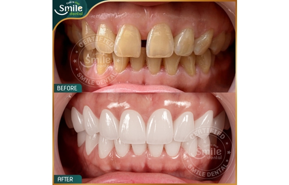 Bọc Răng Sứ 3M Lava Plus Cao Cấp Tại Nha Khoa Smile Cần Thơ