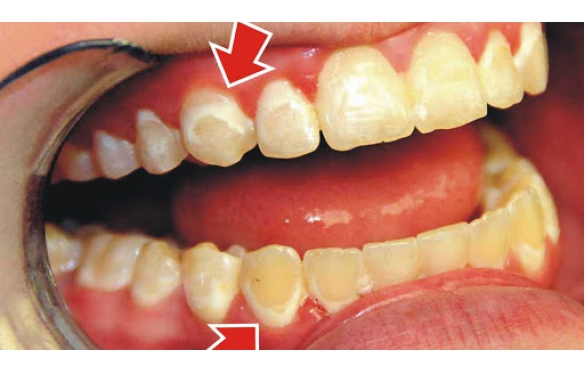 Răng sứ cho răng thiểu sản tại Cần Thơ - Giải pháp hoàn hảo cho nụ cười tự tin